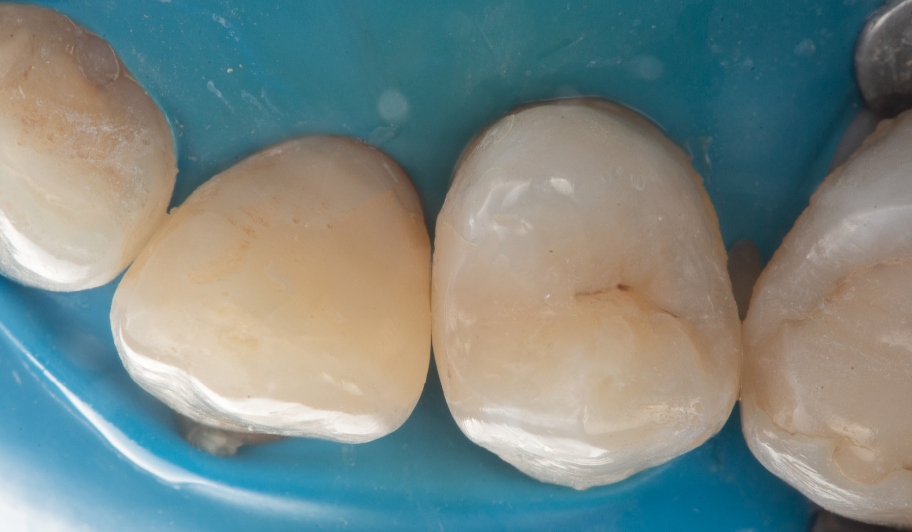 Fig. 9: Occlusal view of the teeth restored with a universal-shade flowable composite